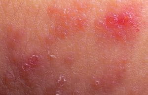 Peau rouge avec inflammation.