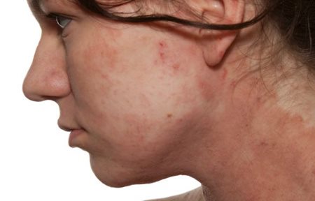 Profil de femme avec la peau des joues rouge.