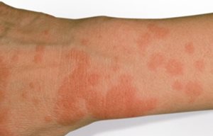 Gros plan sur la peau ayant une réaction photoallergique