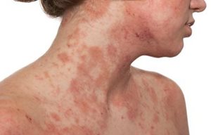 Décolleté et partie inférieure du visage d'une femme dont la peau est infectée.