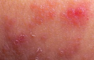 Peau rouge avec inflammation.