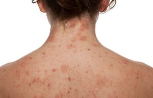 Dos d'une femme sujette à la dermatite atopique