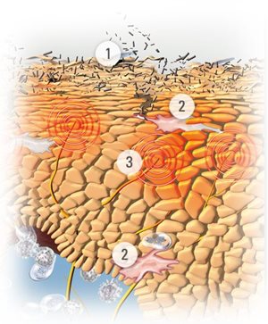 Illustration d'une peau présentant les symptômes d'une dermatite atopique.